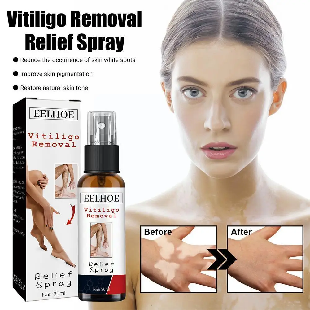 30ml Vitiligo Repair Spray Skin Moisturizing Vitiligo Net Skin Spray Body Remove Fades Vitiligo Spot Relief White Face Spot J6F8