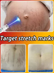 Blu-ray pen Improve Red White Old Stretch Marks Cream For Pregnancy Postpartum Skin Care