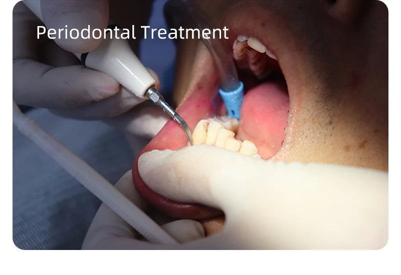 VVDental Ultraschall-Scaler-Maschine mit LED-Licht-Handstück zur Entfernung von Zahnstein und zur Zahnreinigung für Zahnkliniken – Detail 19