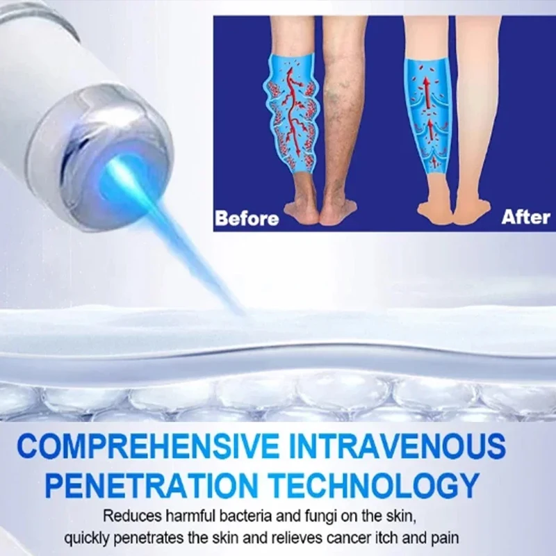 Leg Massage Body Repair Pen Lampshade Therapy For Varicose Veins Effective Relief Leg Fatigue Improved Blood Circulation