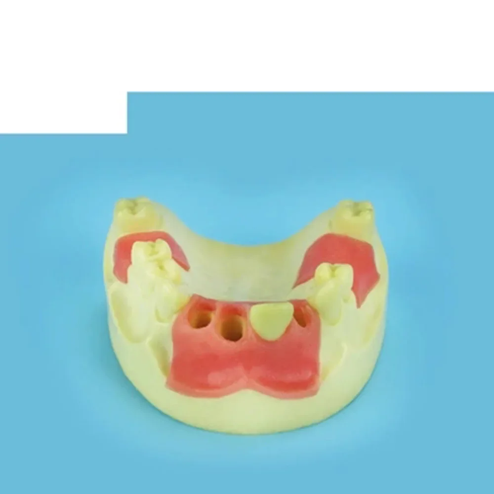 Oral model, maxillary anterior missing implant practice model, dental implant model