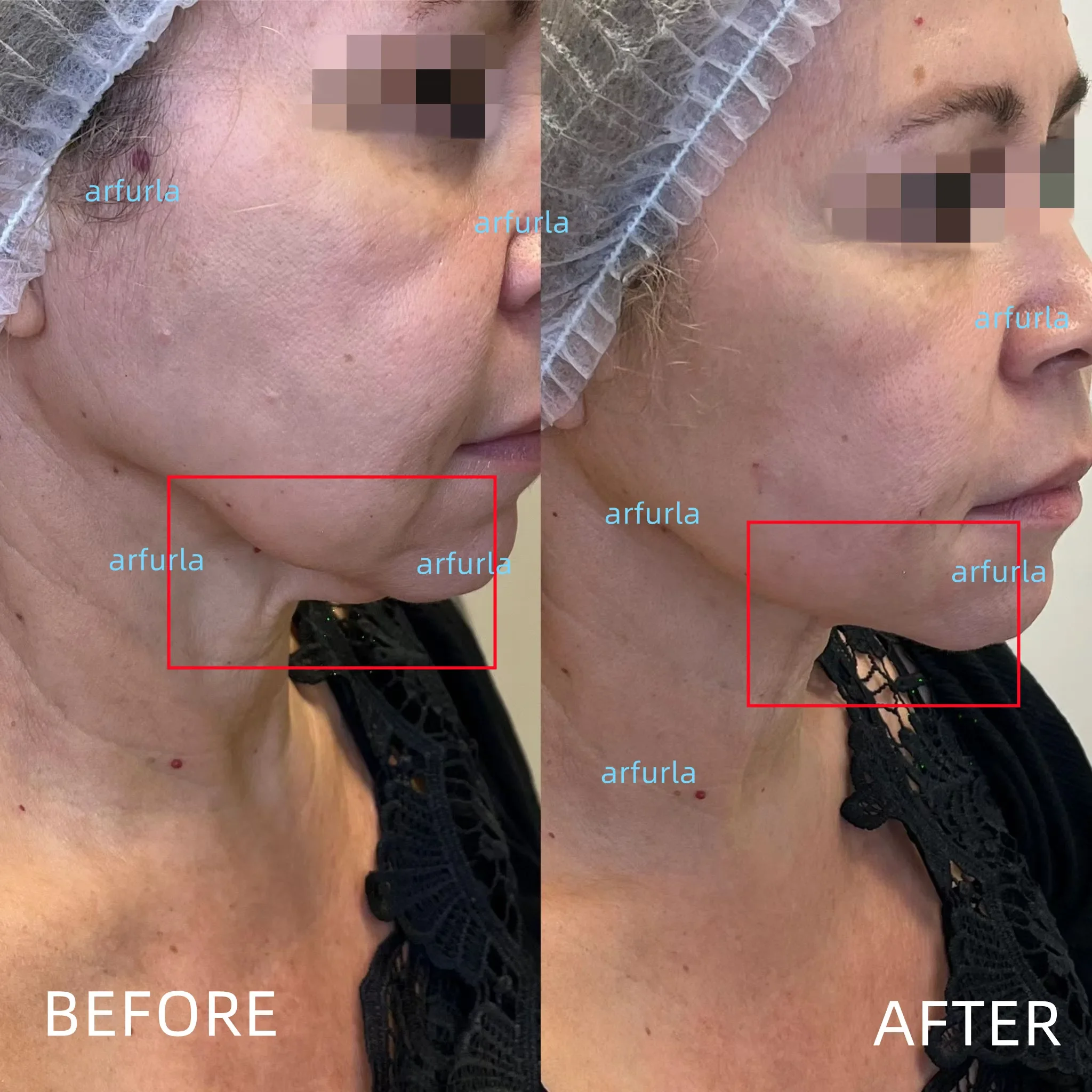 Fibra per lipolisi SMA 905 fibra di consumo medica 400um