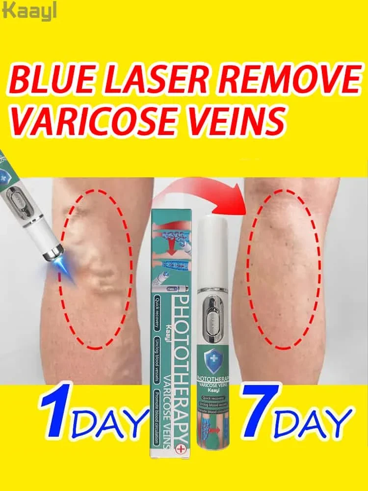 

Laser vein | Improves Blood Circulation | Reduces Spider Veins and Heaviness