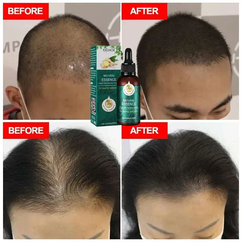 Hair Regrowth Treatment Four Herbs Natural Ingredients Hair Regrowth Product Serum Hair Loss Prevention Series Hair Care New