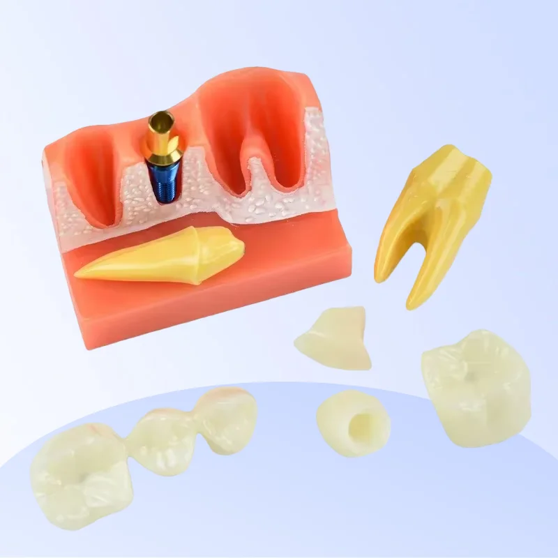 

Dental Teach 4-Times Implant Analysis Crown Bridge Removable Model Dental Demonstration Teeth for Lab Material Simulation