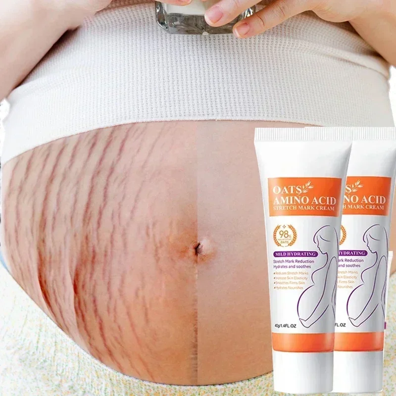 

Striae Repair Cream Removal Acne Scar Stretch Marks Cream Fat Scar Striae Gravidarum Treatment