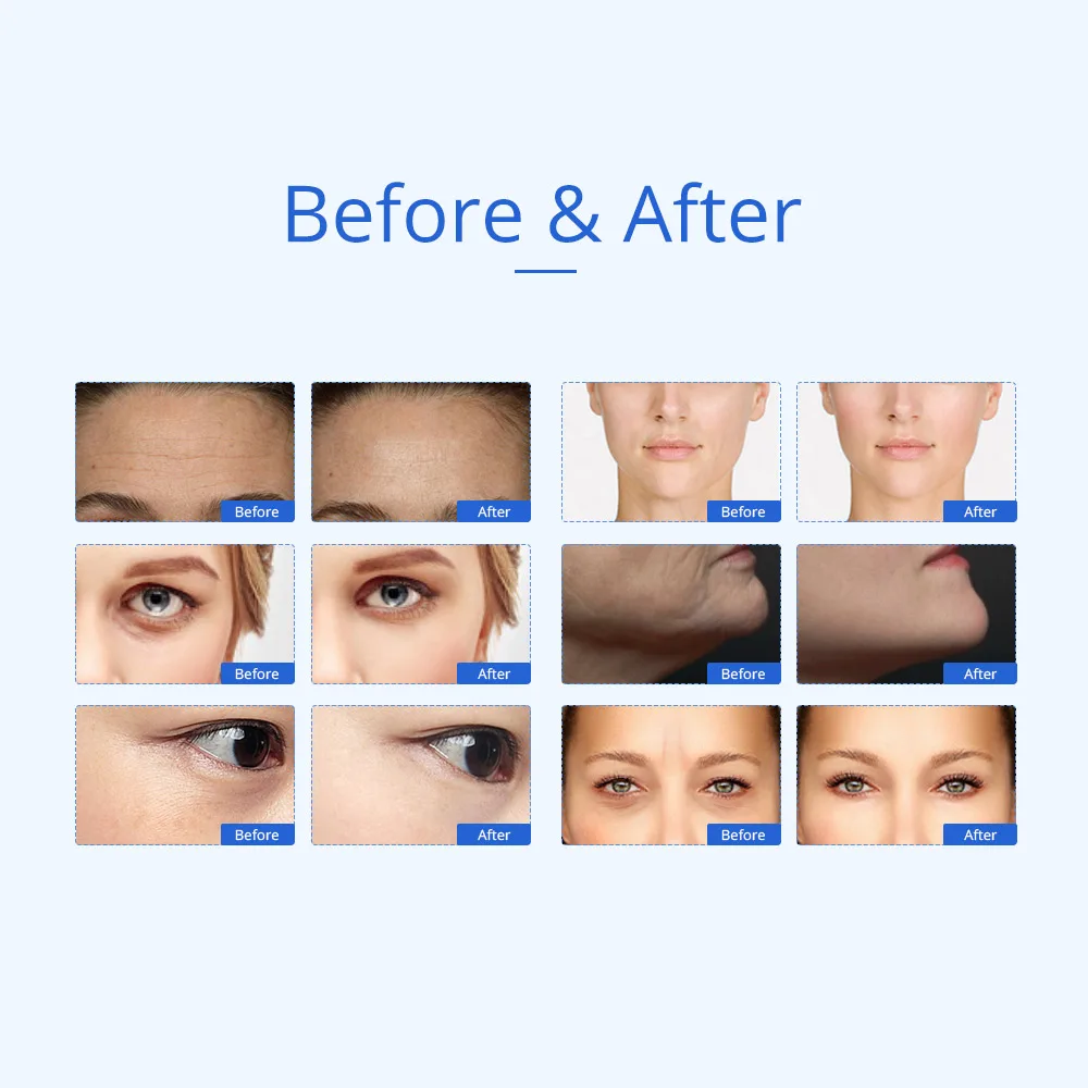 Ems corpo facial máquina de radiofrequência aperto da pele face lifting rf dispositivo beleza profissional casa rf cuidados com a pele anti envelhecimento