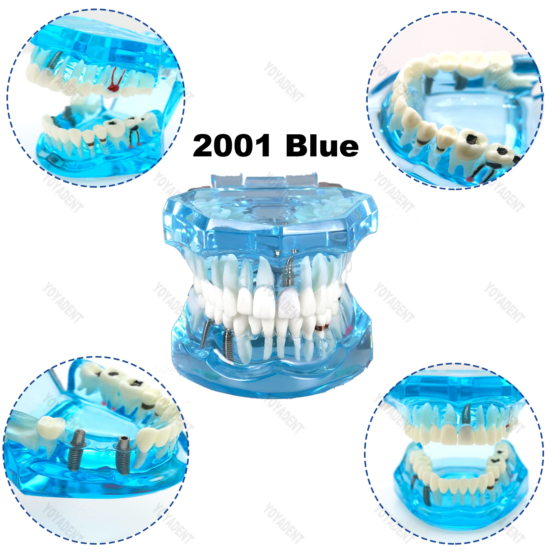 نموذج ترميم زرع الأسنان نموذج لتدريس طبيب الأسنان دراسة طب الأسنان منتجات طب الأسنان المعيار الأزرق 1:1 #3