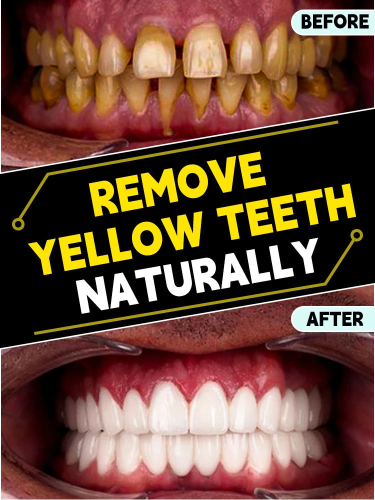 

Whitening mousse 5 days removes dental plaque tartar oral hygiene cleaning fresh bad breath teeth care products