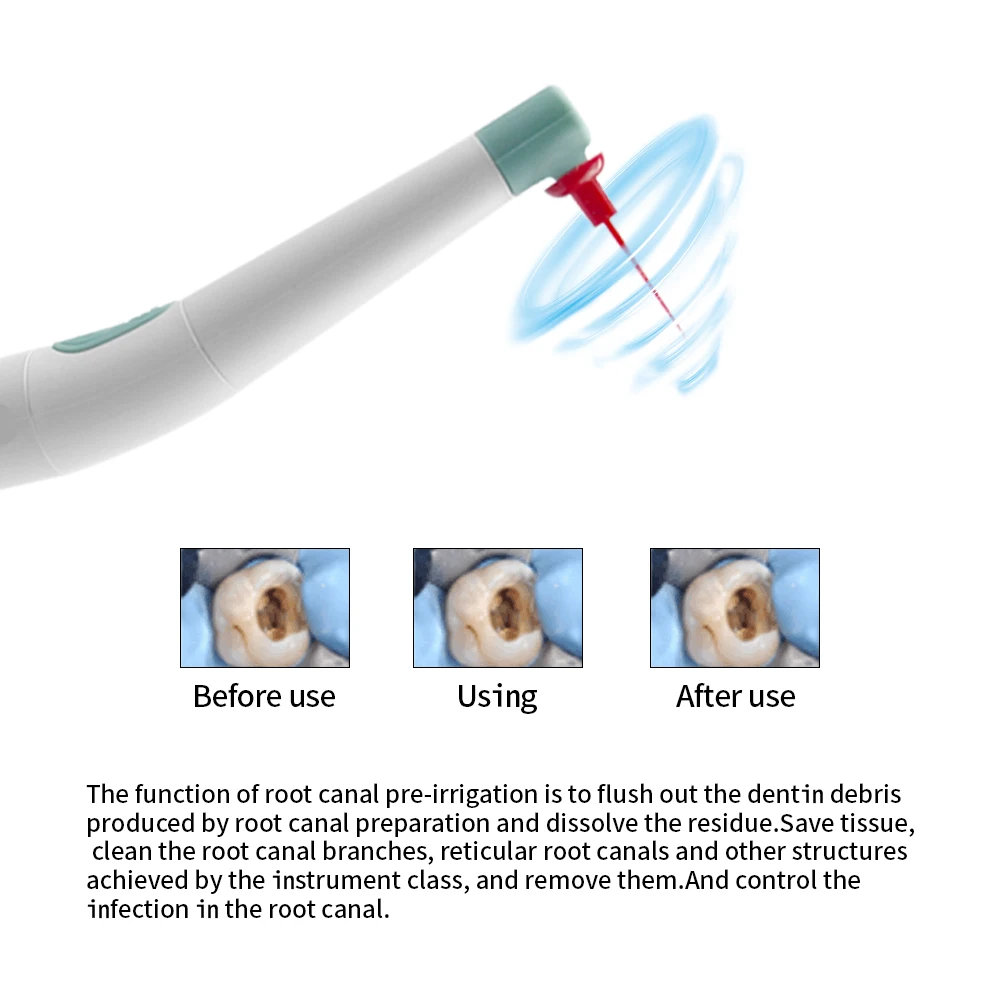 قناة الجذر أعواد قناة طبيب الأسنان الري إندو تنظيف قبضة اللبية سرعة منخفضة إزالة الإبر المكسورة مركبات الكالسيوم