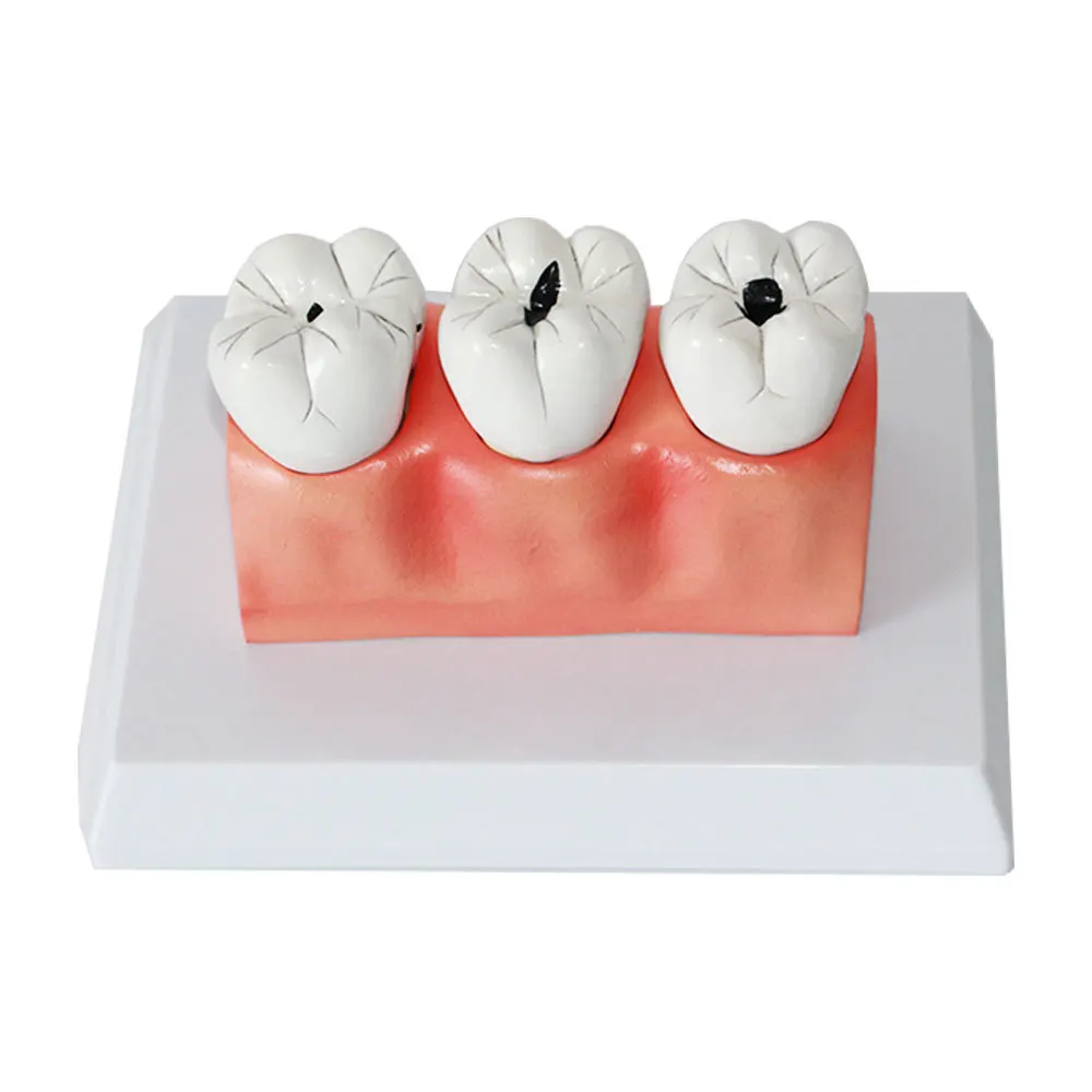 Dental Department: Pediatric Insect Tooth Decay Model, Pathological Caries Anatomy Model