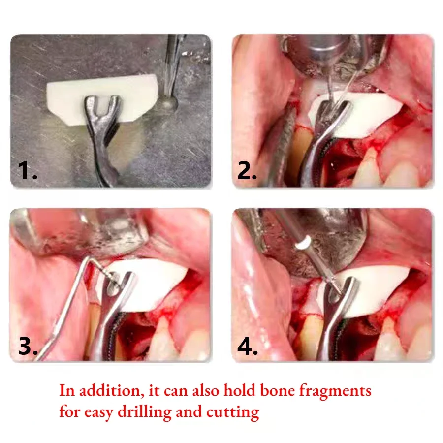 Dental Non Slip Head with Toothed Bone Clamp Forceps for Implanting Incremental Bone Repair Tools