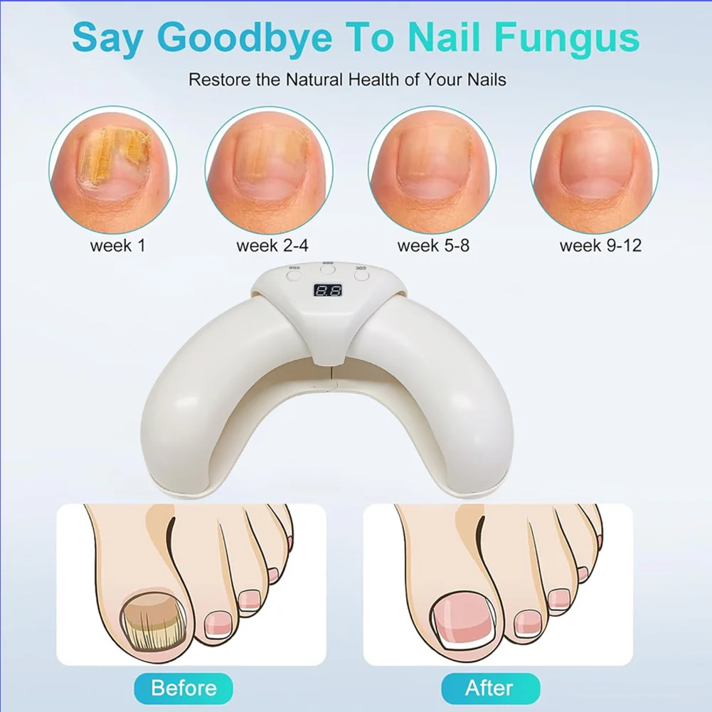 Nail Fungus Treatment LED Laser Device for Cleaning Onychomycosis USB Charge 45W 470nm Blue Light Nail for Discolored & Thickene