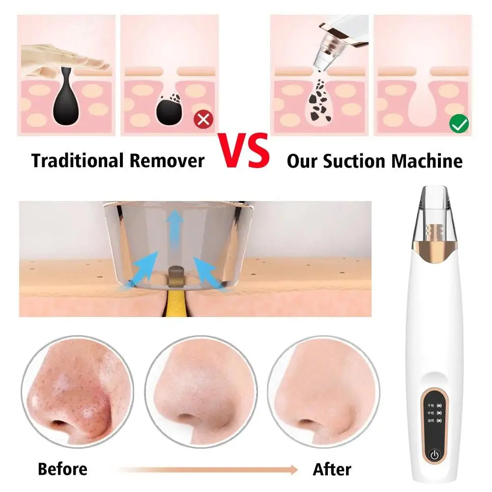 Aspirateur électrique Portable pour éliminer les points noirs, nettoyeur de pores du visage, points blancs, extracteur de boutons et d'acné, Instrument de soins de la peau