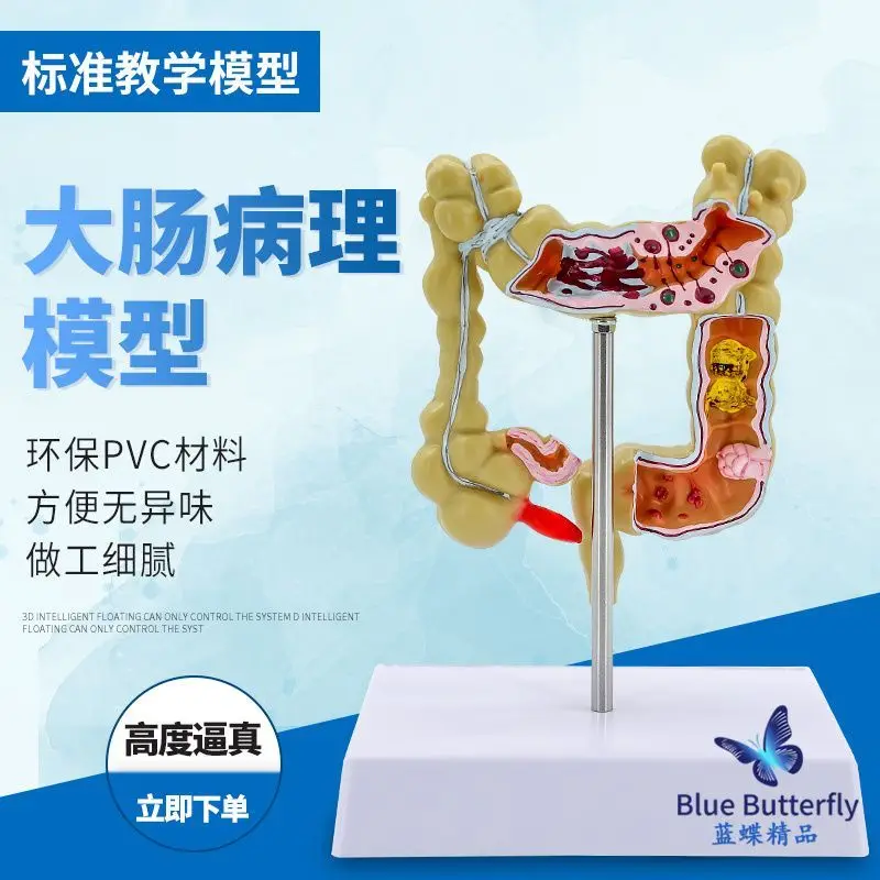 

Large intestine pathology model, gastrointestinal model, large intestine disease model, human colon disease model