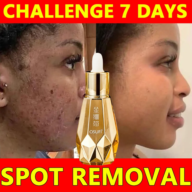 Facial Skin Care Freckle Removal Serum Remove Melasma Lightening Pigmentation Brightening Uniform Skin Tone Nourish Beauty 60ml