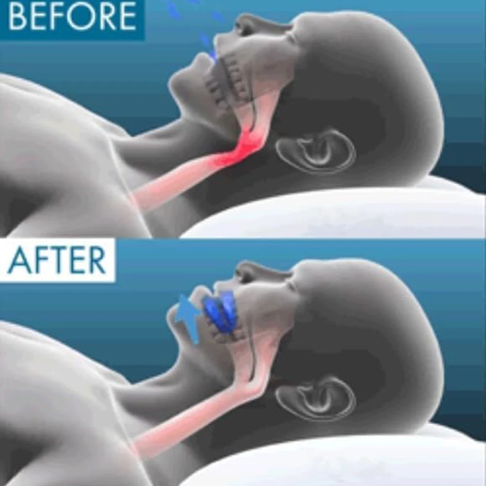 لسان حال فعال مضاد للانتعاش للتوقف عن شخير حارس الفم ناعم مريح في النوم لتحسين استخدام جودة النوم