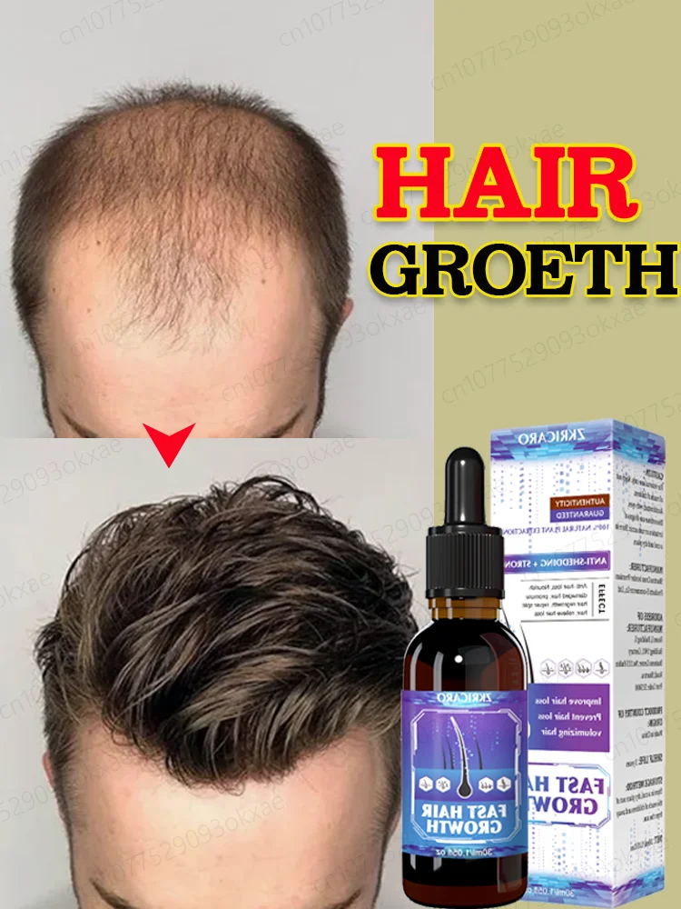 Schnelles Haarwuchs ätherisches Öl repariert Kahlheit, Haarausfall, Ingwer Haarausfall, regeneriert Haarfollikel und Kopfhaut pflege Essenz