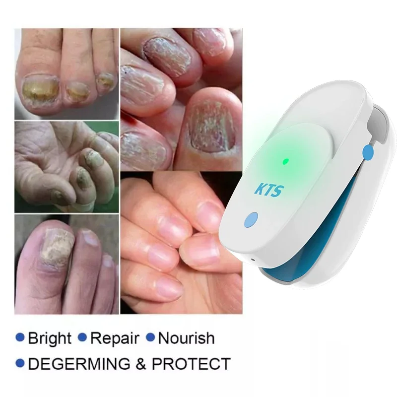 Fungal Nail Laser Device Repair Fast Nails Fungus Onychomycosis Repair Toenail Fingernail Removes Nail Fungus Foot Care Device