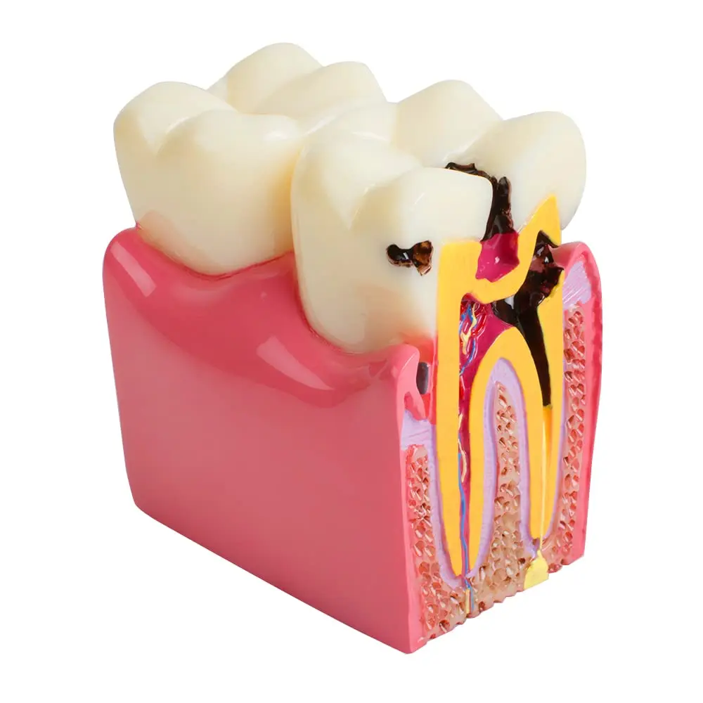 Teeth Model Caries Dental Demonstration Dentist  Patient Communication Models 1pc