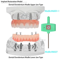 Dental Implant Teeth Model Transparent Upper/Lower Jaw Type All on 4 Overdenture Modle With 4 Removable Screws