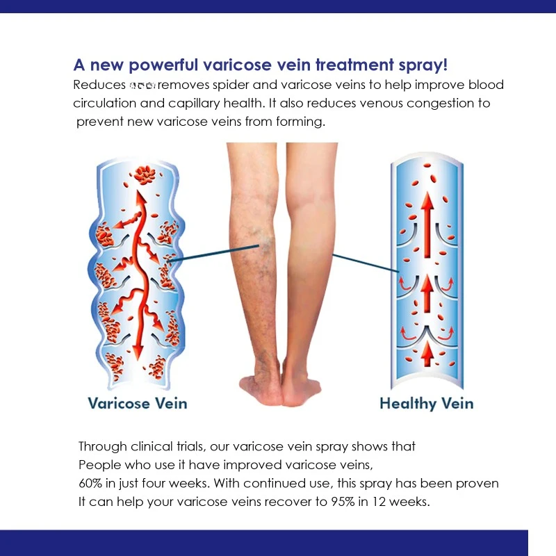 بخاخ دوالي الوريد لتنعيم الأرجل ، كريم التهاب الوريد الوريدي الوعائي ، علاج انتفاخ الأوعية الدموية ، منتج العناية بجسم الساق الاحمرار ، 30 *