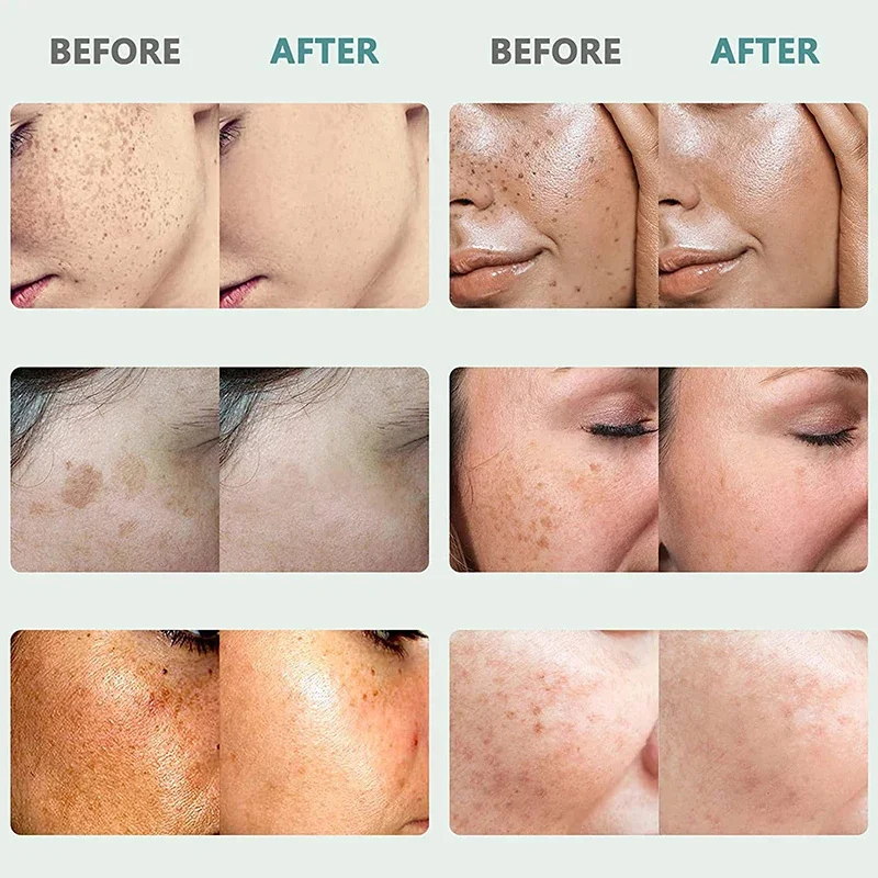 Crema Facial para eliminar puntos negros, Corrector de pecas, blanquea el melasma, antimanchas marrones, aclara la pigmentación, hidrata el cuidado de la piel Facial