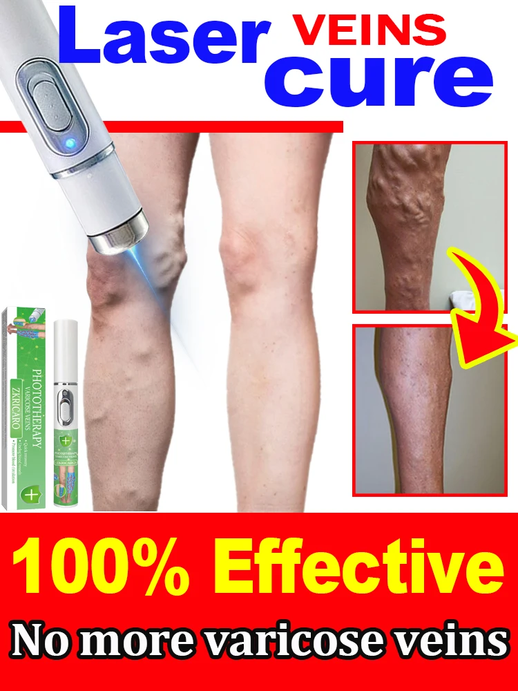 Varicose veins powerful laser