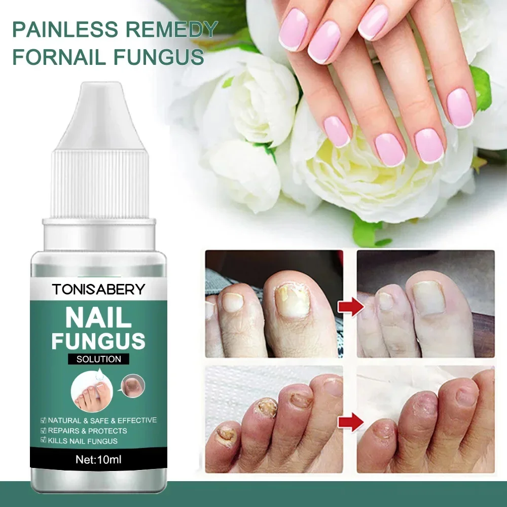 เชื้อราเล็บ Treatment Serum Foot Repair Liquid Toe เล็บ Fungal Removal GEL Anti Infection Paronychia Onychomycosis ครีม 10ml