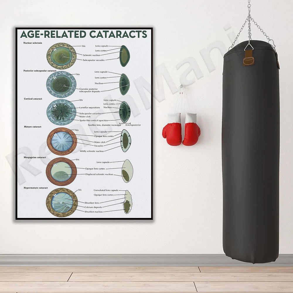 Eye related cataract poster, cataract awareness wall art, eye health wall decoration, eye disease anatomy diagram art print