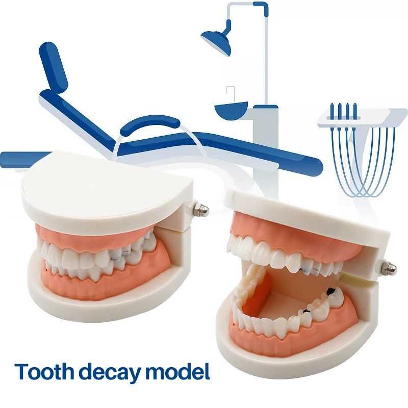 1pc Dental Model Dental Caries Model Teeth Periodontal Disease Model Dentist Material Dental Teaching Models Study