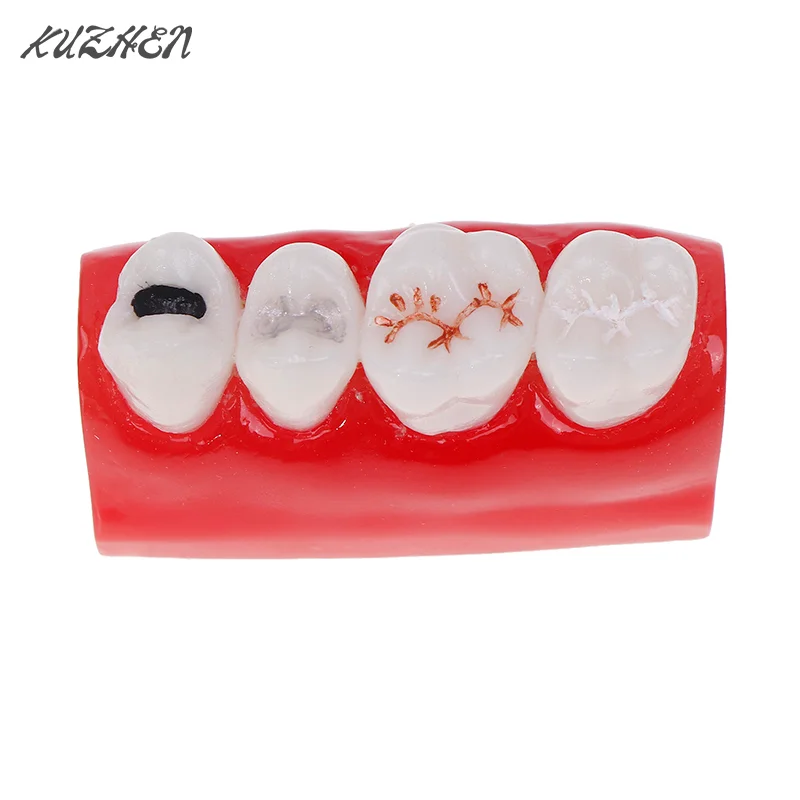 

Dental Resources Sealants Demonstration Dental Study Model Dental Pit And Fissure Closed Model Treatment Teeth Model