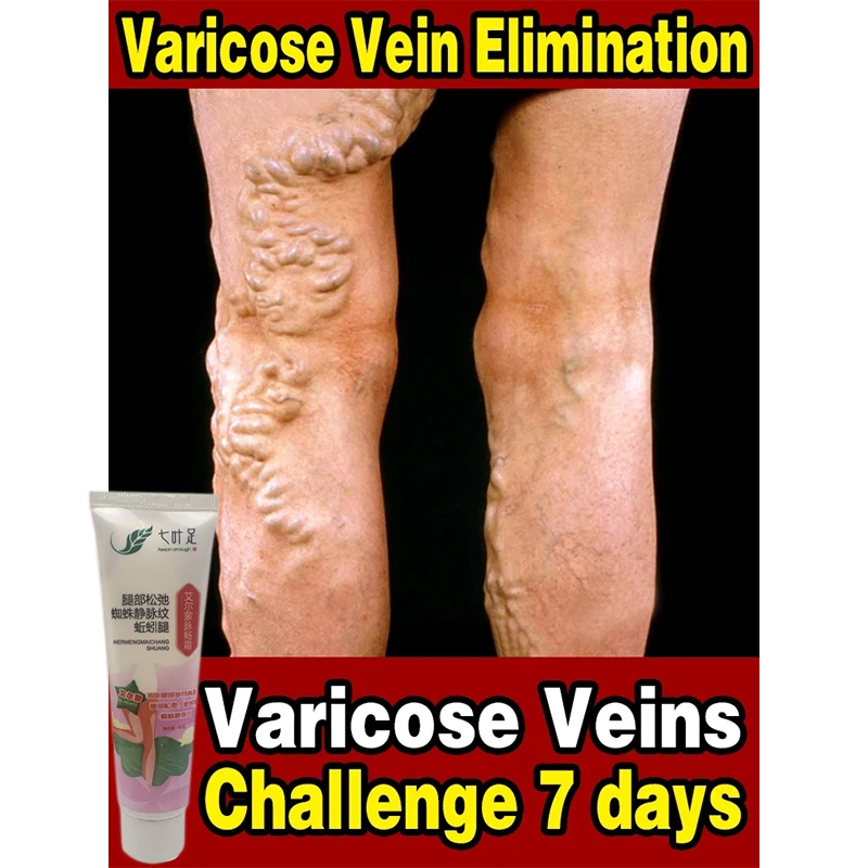 5pcs 20g Varicose Vein Cream Legs Dilated Vasculitis Phlebitis Pain Treatment Ointment Earthworm Vein Repair Care Dressing