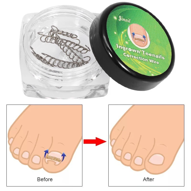 Toenail Brace Convenient Comfortable Professional Pedicure Tools Toe Nail Correction Paronychia Correction Tools Instant Results