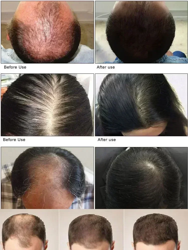 Nutre y cuida el cabello para hombres y mujeres, tratamiento de reparación de cabello con crecimiento, adelgazamiento de cabello seborreico, tratamiento de Alopecia