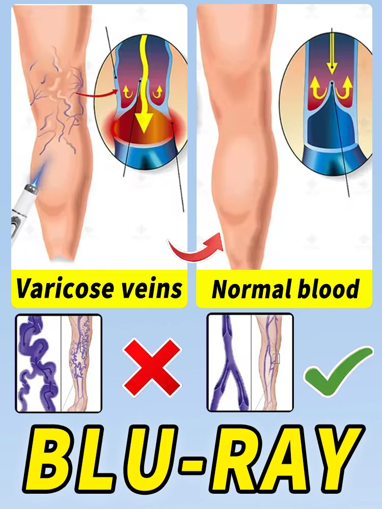 

Solve problems such as spider legs, varicose veins, phlebitis, etc. Improve blood vessels