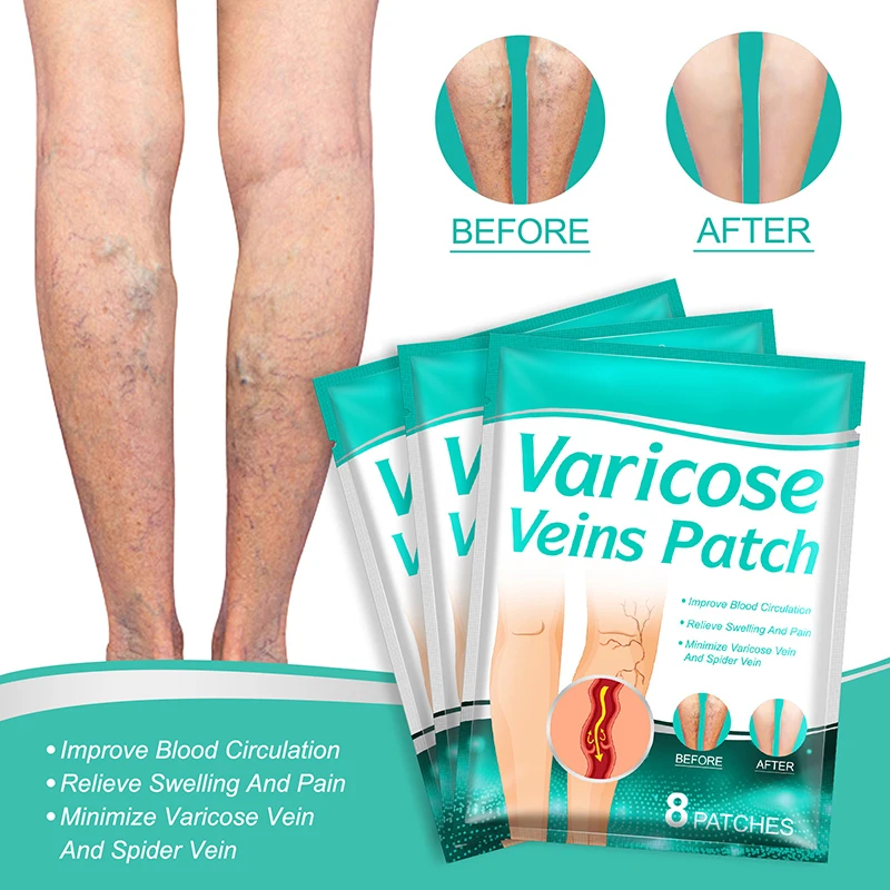 8 PCS Varicose Veins Patch Treatment For Varicose Veins Vasculitis Phlebitis Spider Leg Medical Patch Angiitis Removal Patch