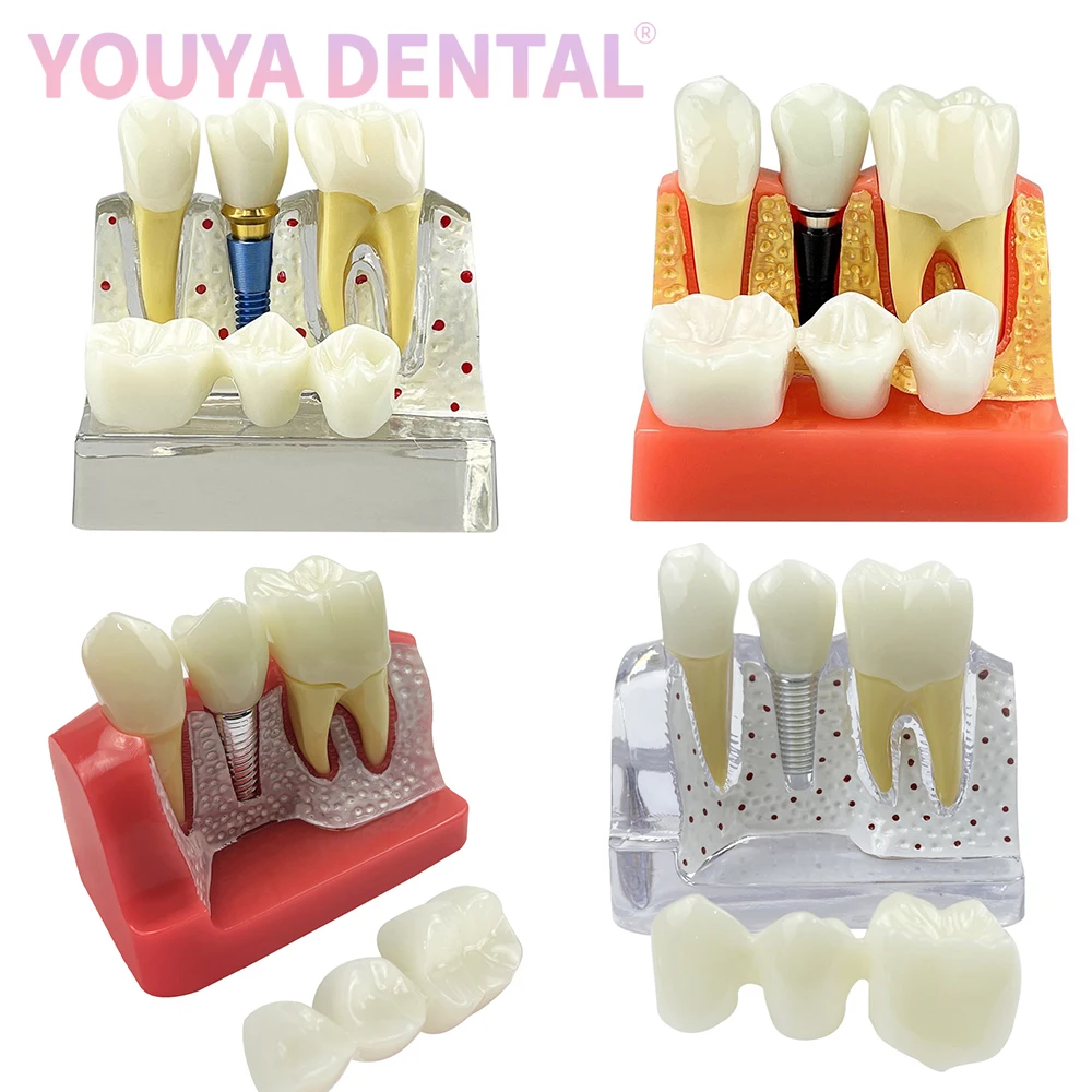 

Teeth Practice Model 4 Times Implant Model For Dentist Student Demonstration Module Medical Science Disease Teaching Model