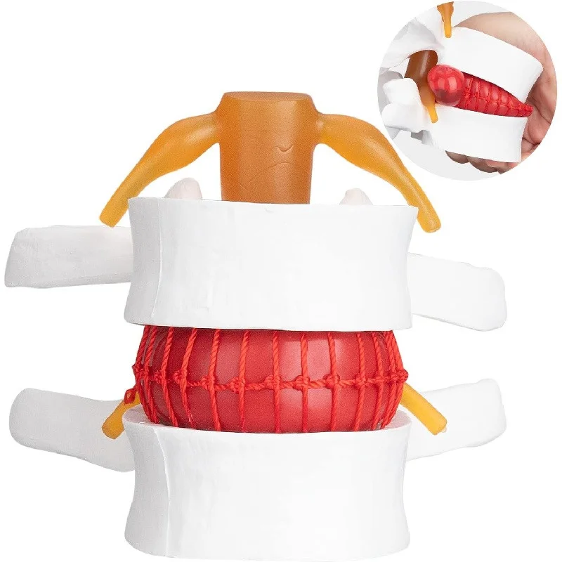 

3D модель грыжа поясничного диска в человеческом теле, анатомии и медицинским обучающим инструментом для поражения позвоночника