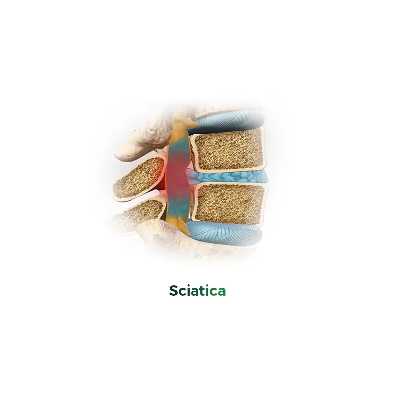 Chinese Manufacturer Radial Shockwave Scraping Electrotherapy Therapy for Sciatica