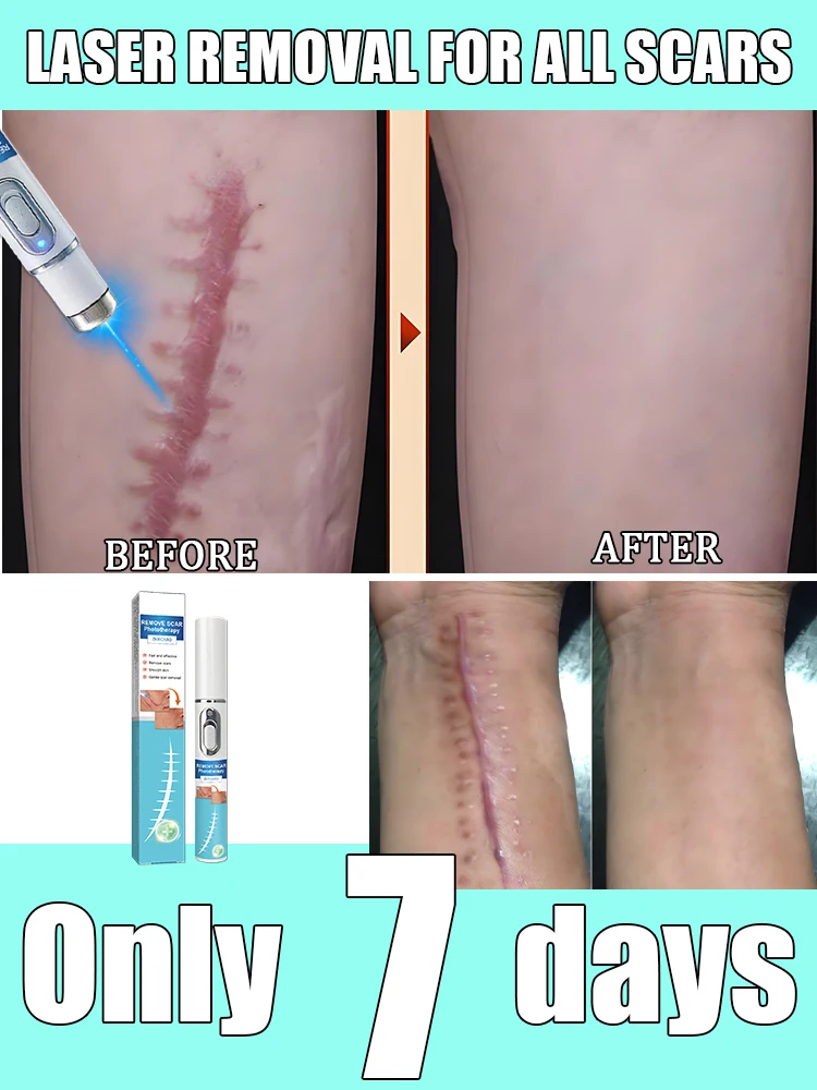 

Effectively fade scar hyperplasia and protrusion,ᴱᶠᶠᵉᶜᵗⁱᵛᵉˡʸ ᶠᵃᵈᵉ ˢᶜᵃʳ ʰʸᵖᵉʳᵖˡᵃˢⁱᵃ ᵃⁿᵈ ᵖʳᵒᵗʳᵘˢⁱᵒⁿ