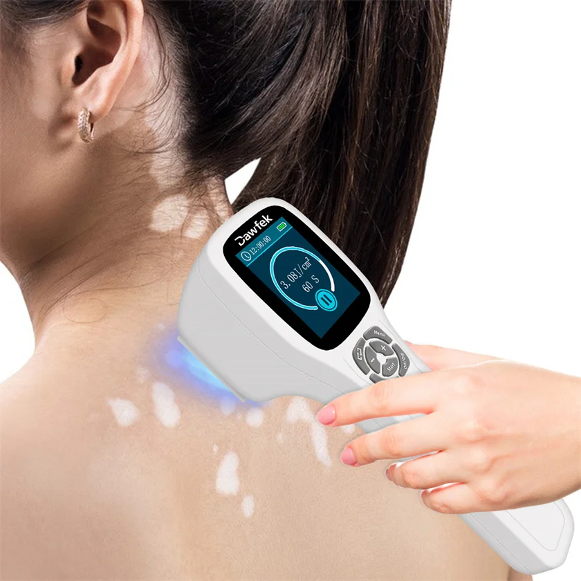 Vitiligo Light Therapy UV Light 308nm for Psoriasis Dermatitis Eczema Best Led Light Treatment Device for Skin Peeling on Hands