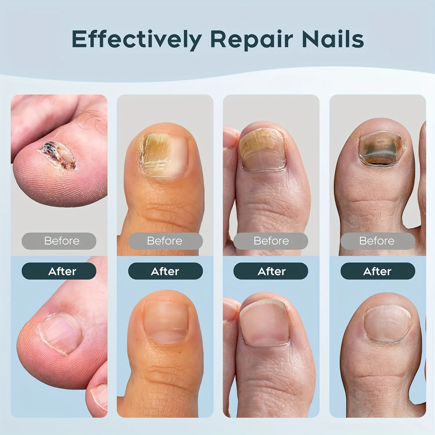 

1/2/4 Pcs Nail Fungus Light Device for Multiple Fingernails & Toenails