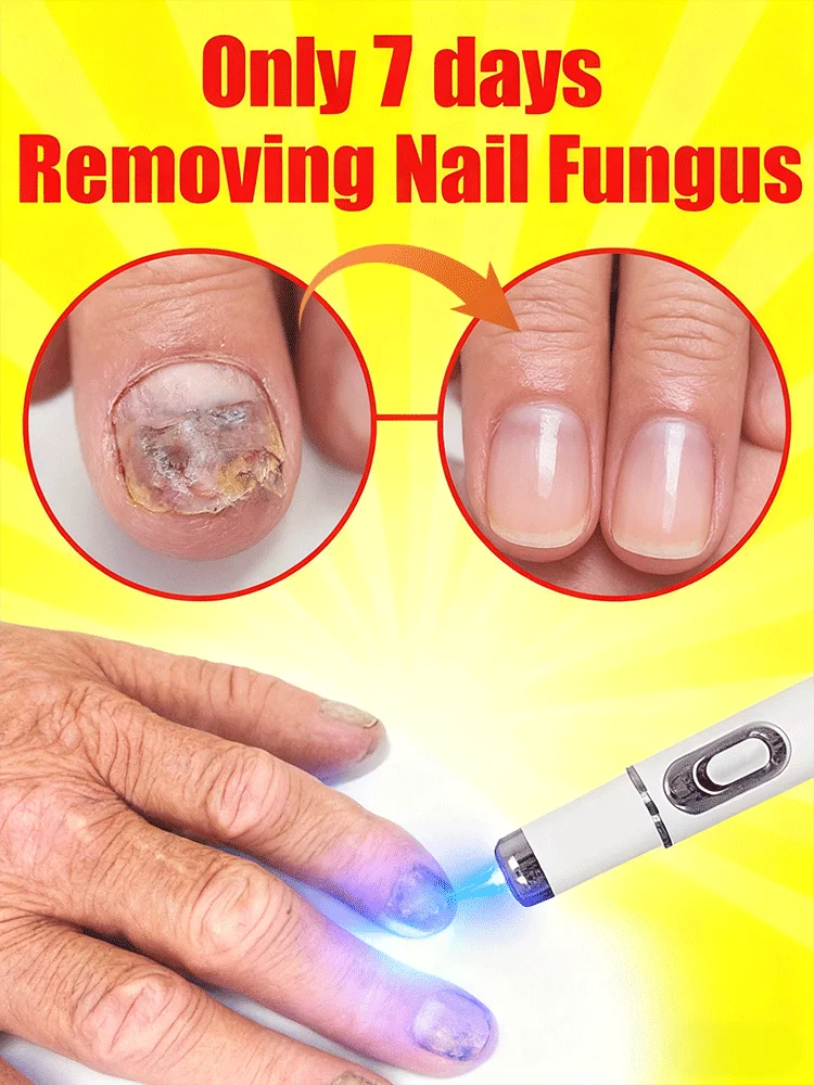 

Fungus nail laser pointer helps to get rid of onychomycosis gray nail Painless and long-lasting sterilization anti-recurrence