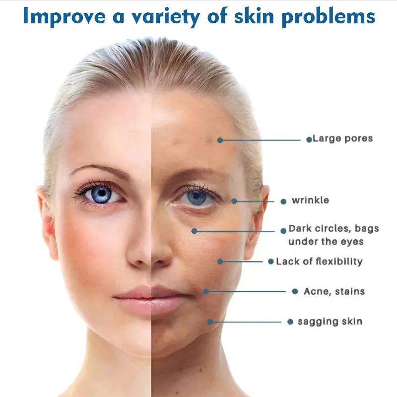 Рисунок 2 - Кислородная дермабразия 7 в 1