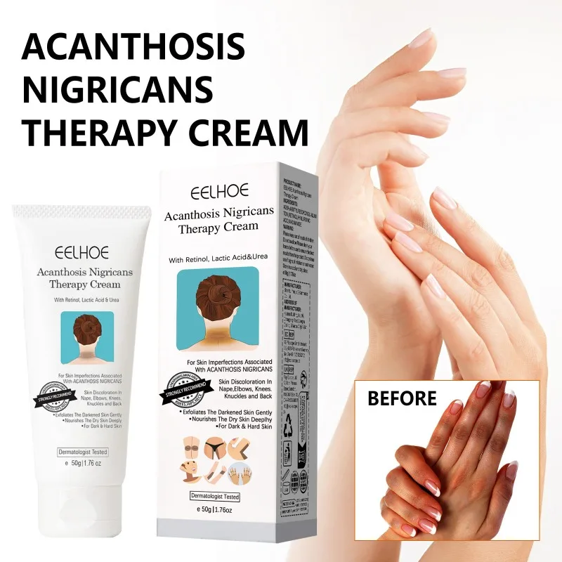 

Крем для тела Acanthosis Nigricans Улучшает текстуру кожи Питает потрепанные районы Легко наносится