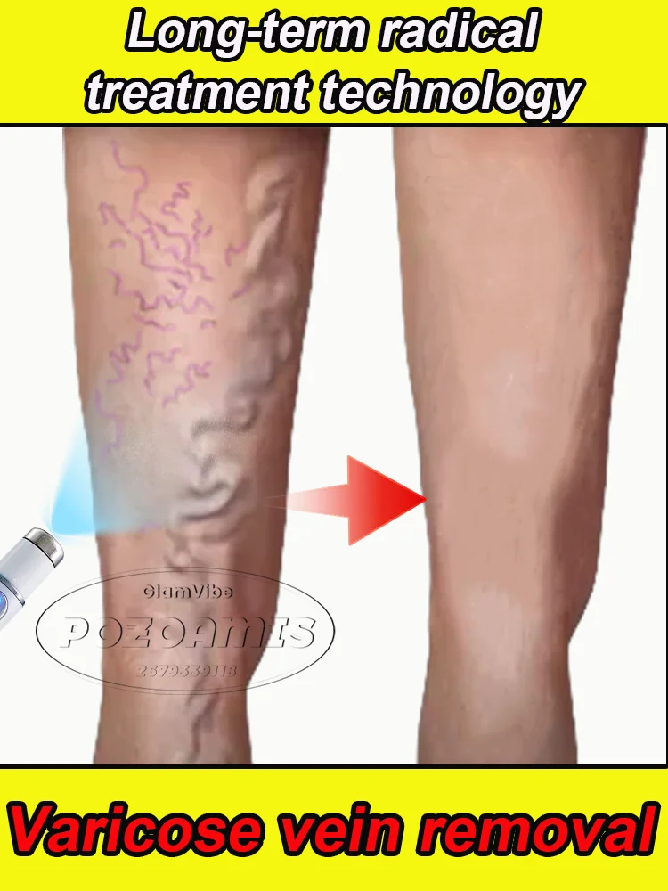 

Blood circulation phlebitis vasculitis anti-swelling blood vessel expansion pain varicose veins equipment laser treatment