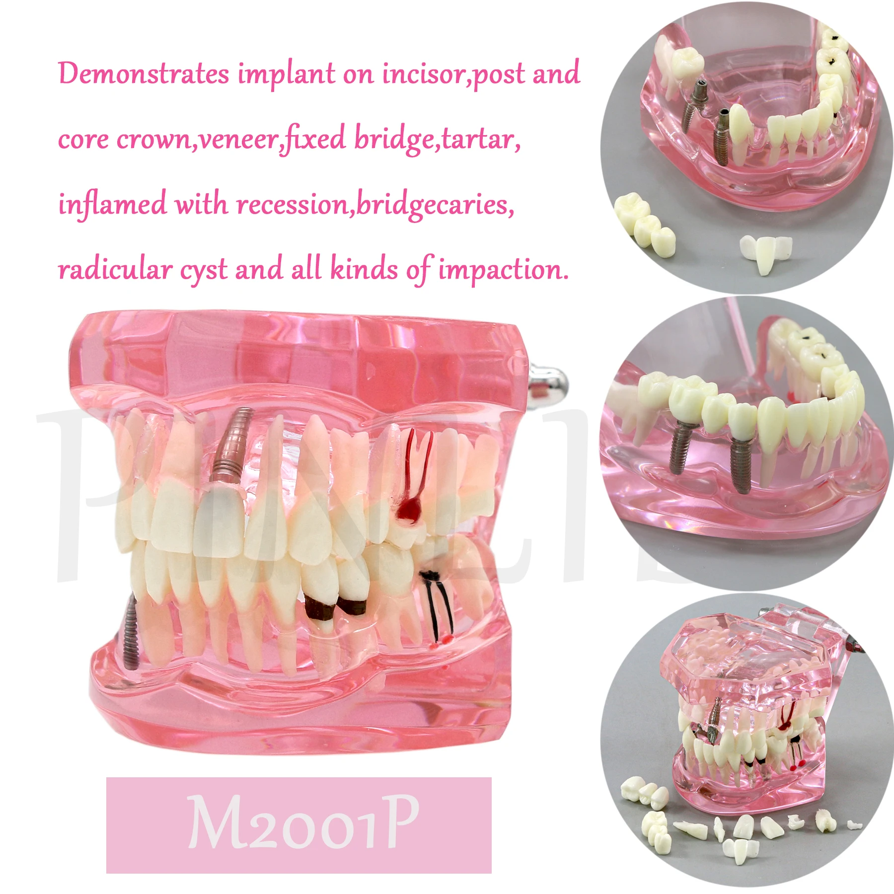 

M2001 Pink Dental Teeth Model Teaching Model Implant Disease Teeth Repair Restoration Bridge for Dentist Teaching Studying Demo