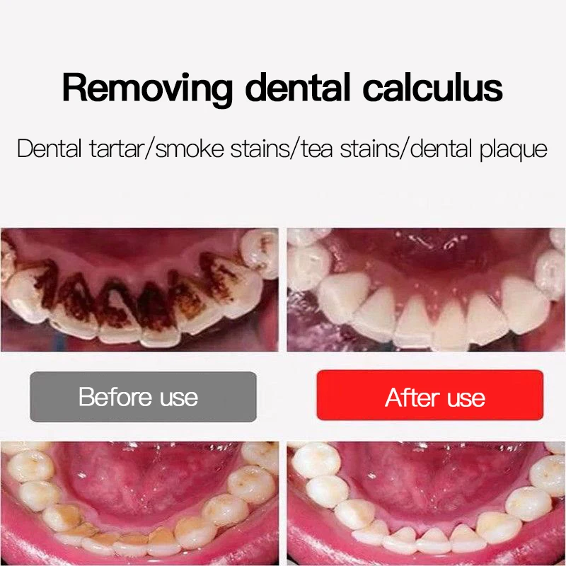 Electric Tooth Cleaner, Household Tooth Cleaner, High Frequency Stone Remover, Tooth Whitening Instrument, Tartar Remover