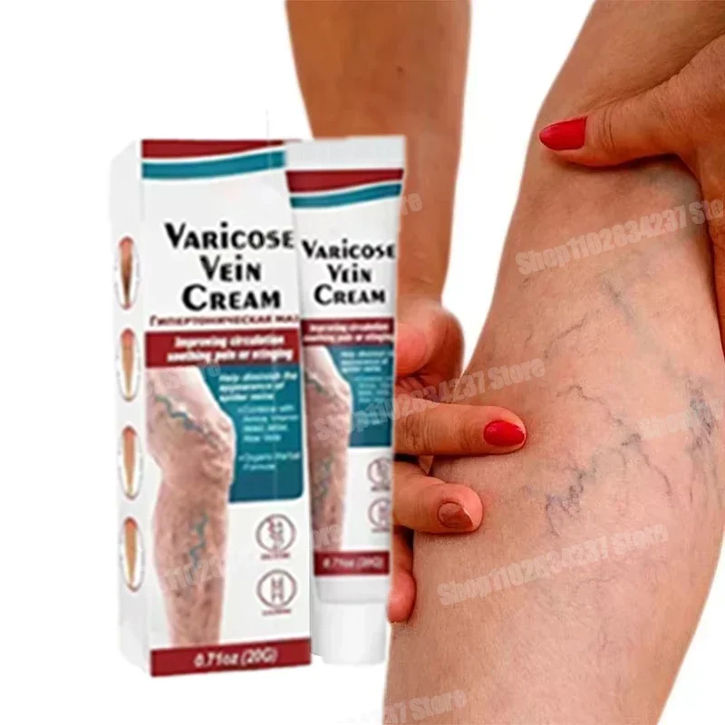 Varicose Vein Cream Spider Vein Pain 2024